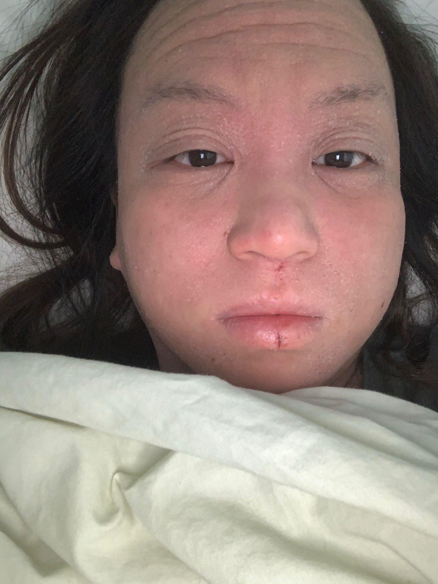 Living with eczema by Kat S. - fjör