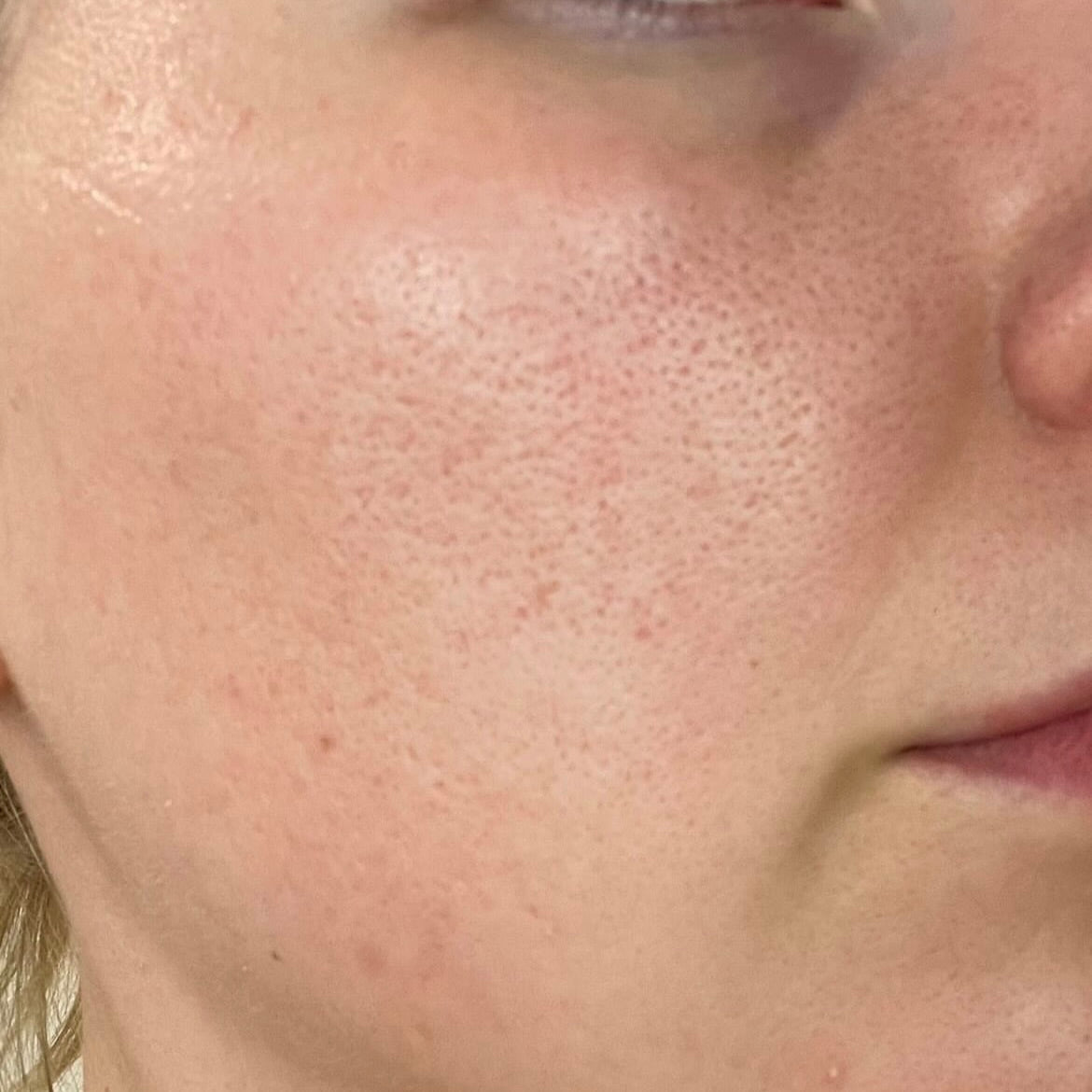close-up image of a person's face in a before picture to showcase their dull skin condition before treatment
