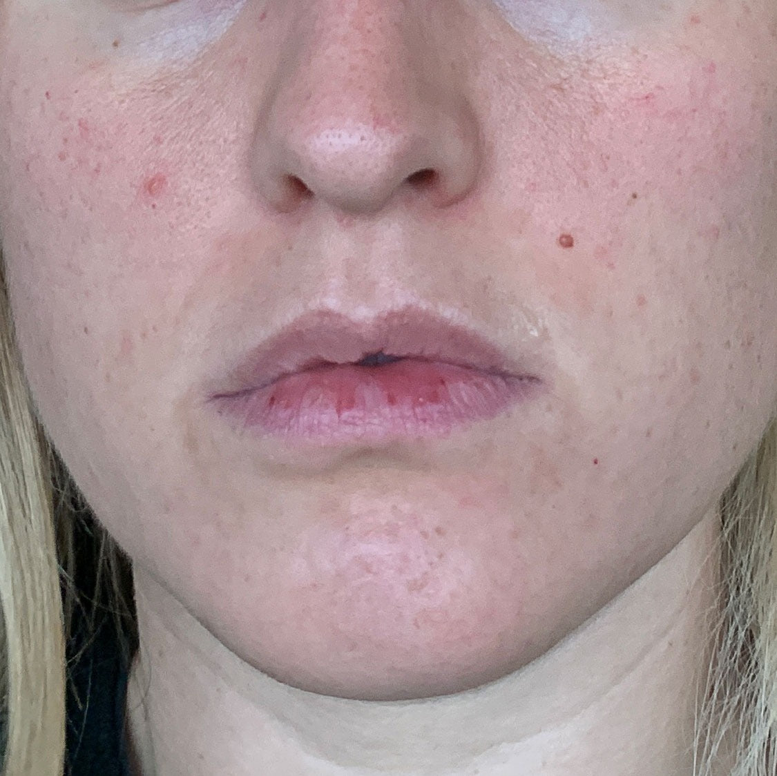 close-up image of a person's face in a before picture to showcase their irritated skin condition before treatment