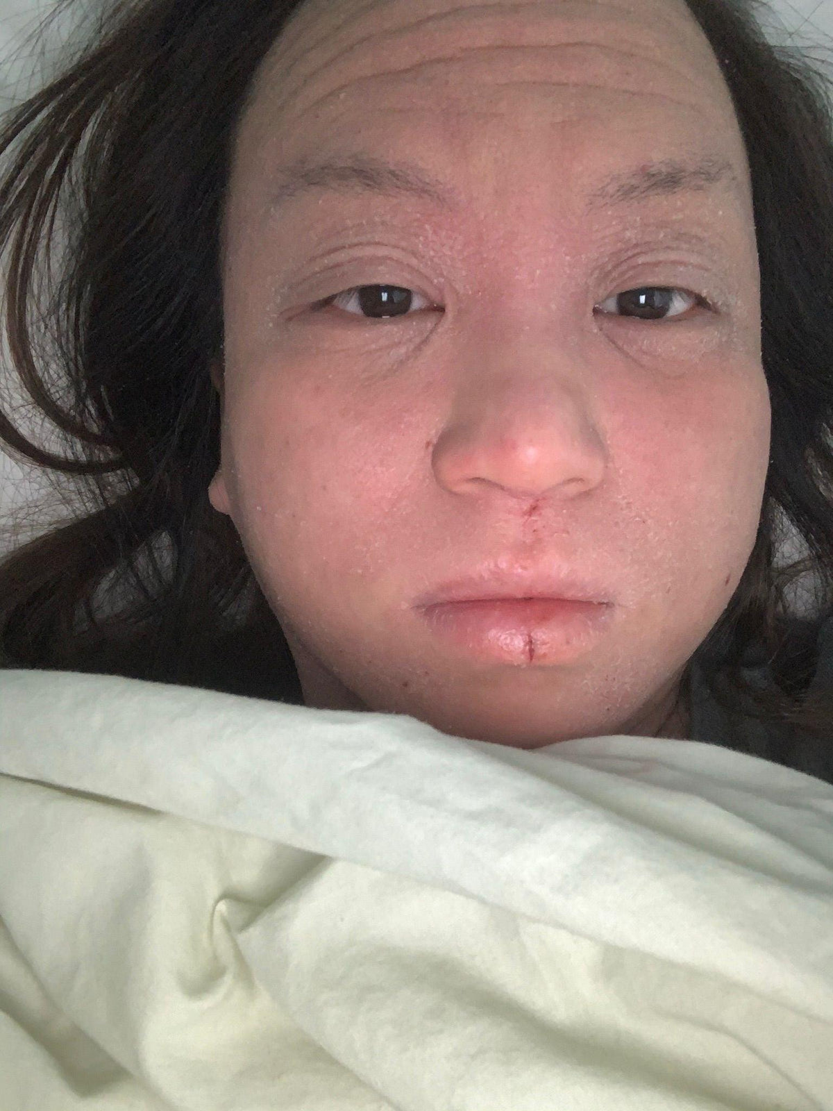 Living with eczema by Kat S. - fjör