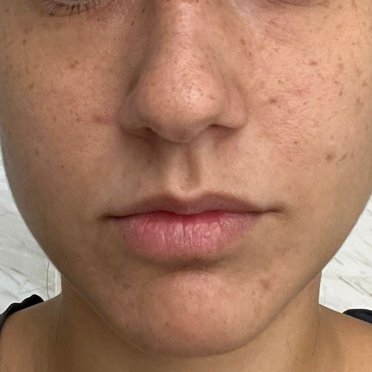 close-up image of a person's face in a before picture to showcase their skin condition before treatment