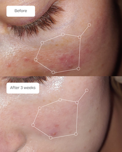 Before and after improvement comparison of skin around an eye with rosacea over 3 weeks 