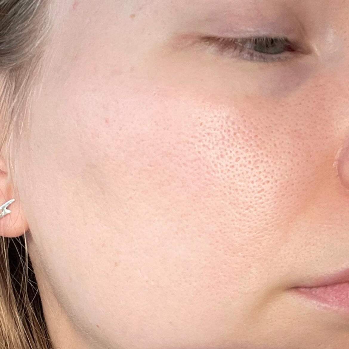 close-up image of a person's face in a after picture to showcase their radiant skin condition after treatment