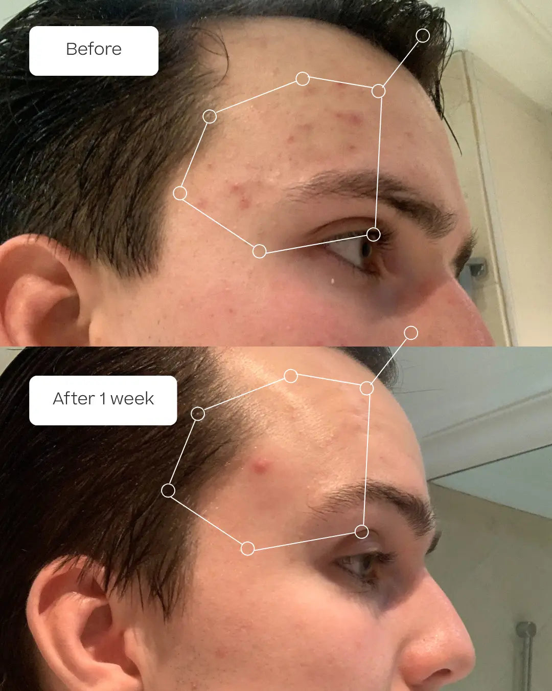 A before-and-after split comparison of a man's forehead, showing acne and redness on the top labeled 'Before' and clearer skin after 1 week on the bottom labeled 'After 1 week'. White line drawings outline the forehead area in both panels.