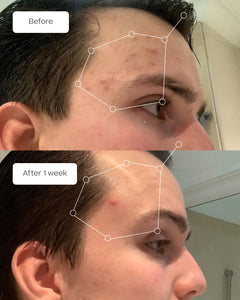 A before-and-after split comparison of a man's forehead, showing acne and redness on the top labeled 'Before' and clearer skin after 1 week on the bottom labeled 'After 1 week'. White line drawings outline the forehead area in both panels.