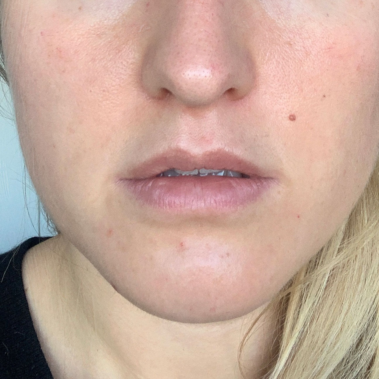 close-up image of a person's face in a after picture to showcase their improved skin condition after treatment