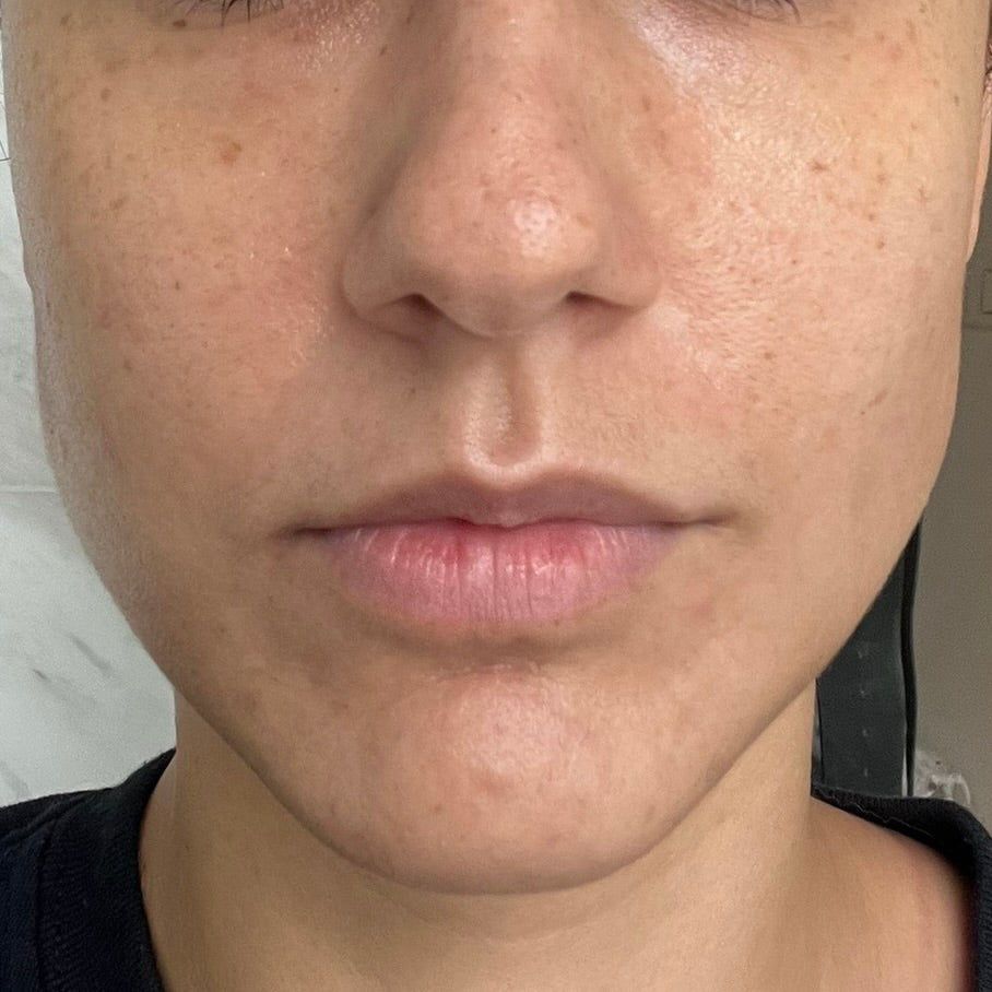 close-up image of a person's face in a after picture to showcase their improved skin condition after treatment
