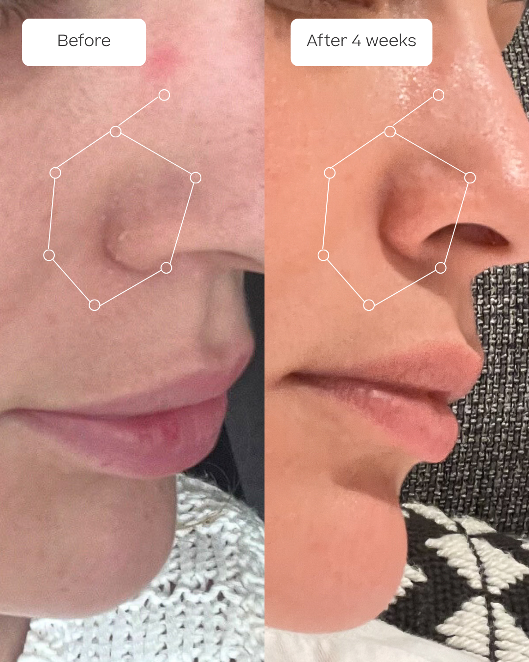 Before and after comparison of the fjor hydrolytic face moisturizer highlighting the nose area dryness