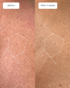 A side-by-side before-and-after comparison showing skin texture and tone improvement over 4 weeks using the hydrolytic body moisturizer