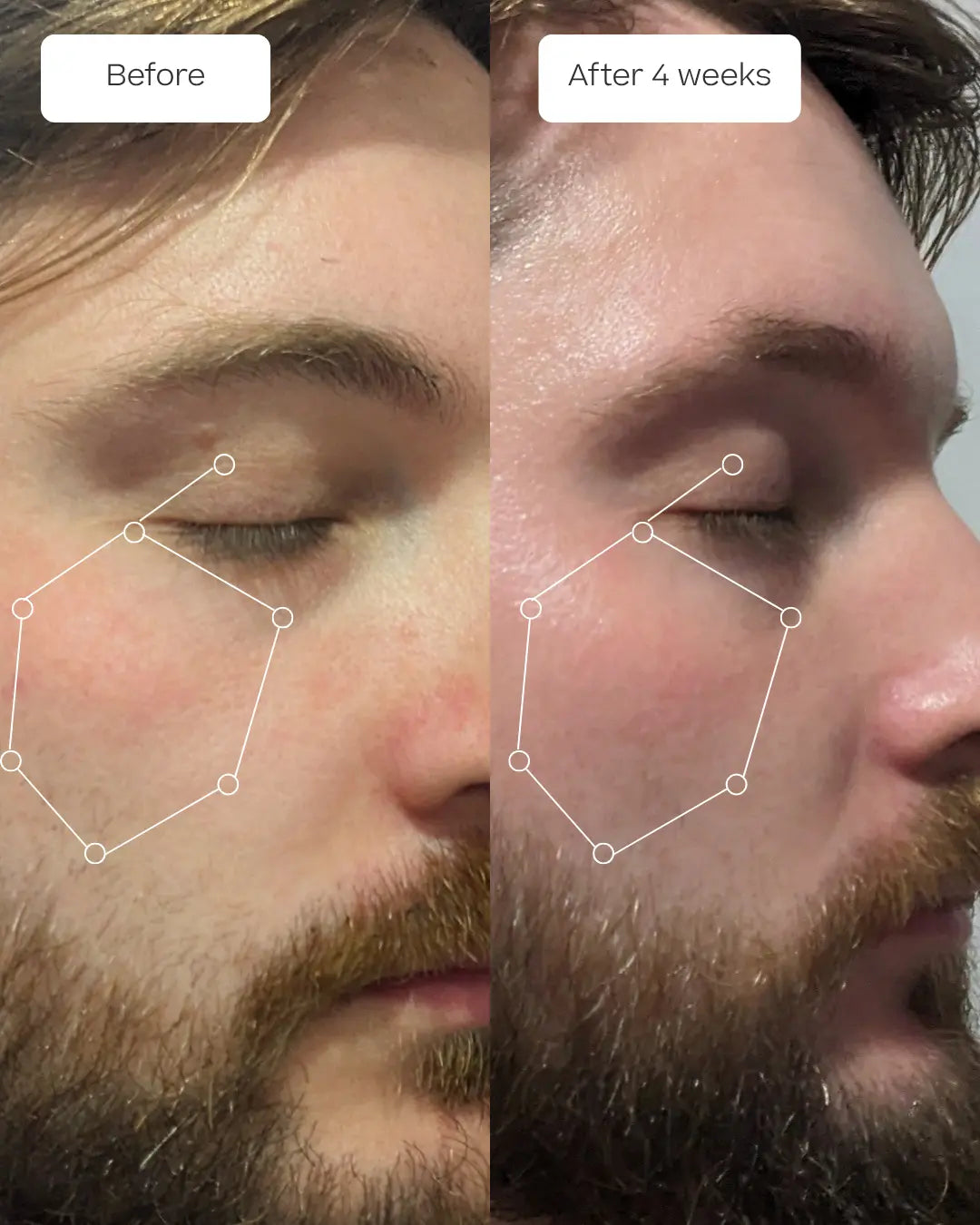 A side-by-side before-and-after facial comparison of a bearded man's eye and cheek area, labeled 'Before' and 'After 4 weeks,' with white line overlays highlighting skin texture and appearance changes.