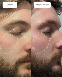 A side-by-side before-and-after facial comparison of a bearded man's eye and cheek area, labeled 'Before' and 'After 4 weeks,' with white line overlays highlighting skin texture and appearance changes.